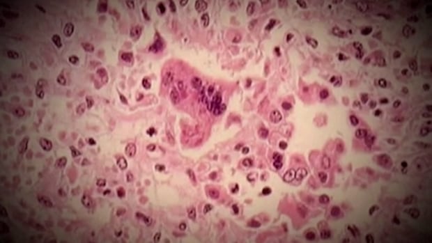 Measles risk prompts airport, hospital caution for travelers and patients