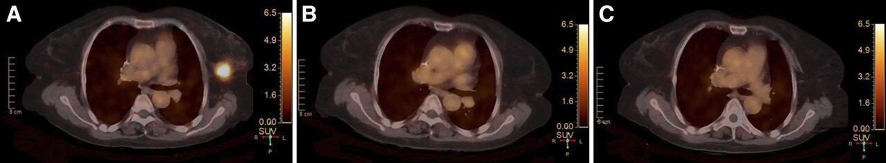 Molecular imaging offers new hope for precise breast cancer treatment monitoring