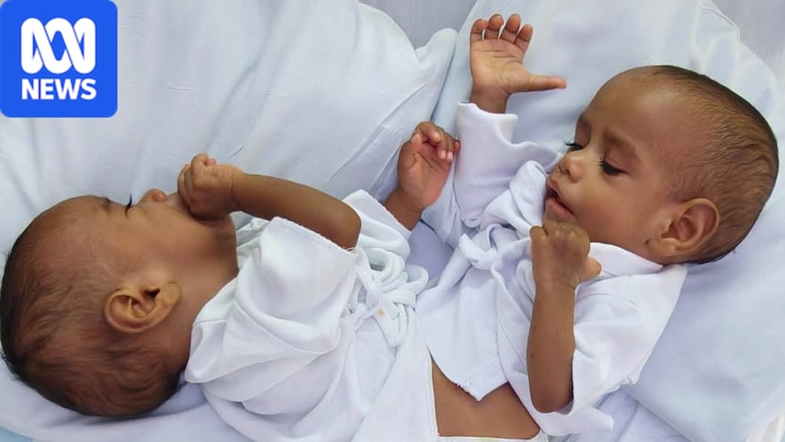 Rare surgical feat brings hope to families of conjoined twins worldwide